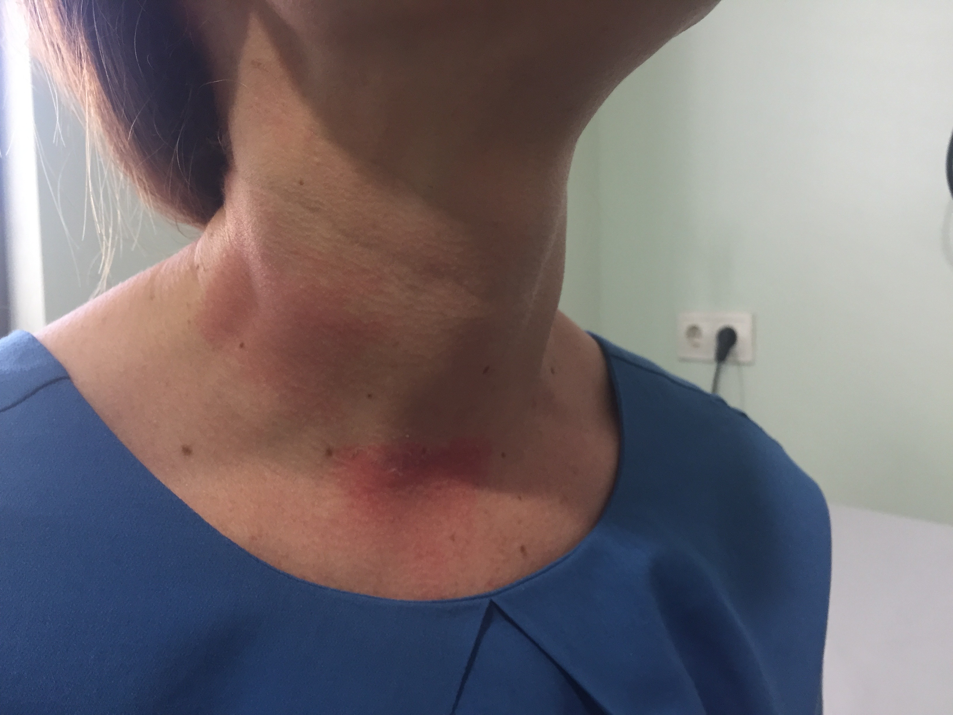 Patología Benigna Tiroidea